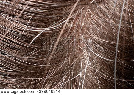 Macro Photo Of Human Hair With Dandruff. Head Wounds And Itching, Hair Care, Seborrheic Treatment