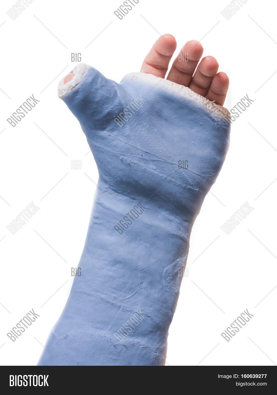close up of a blue arm plaster / fiberglass cast with the thumb