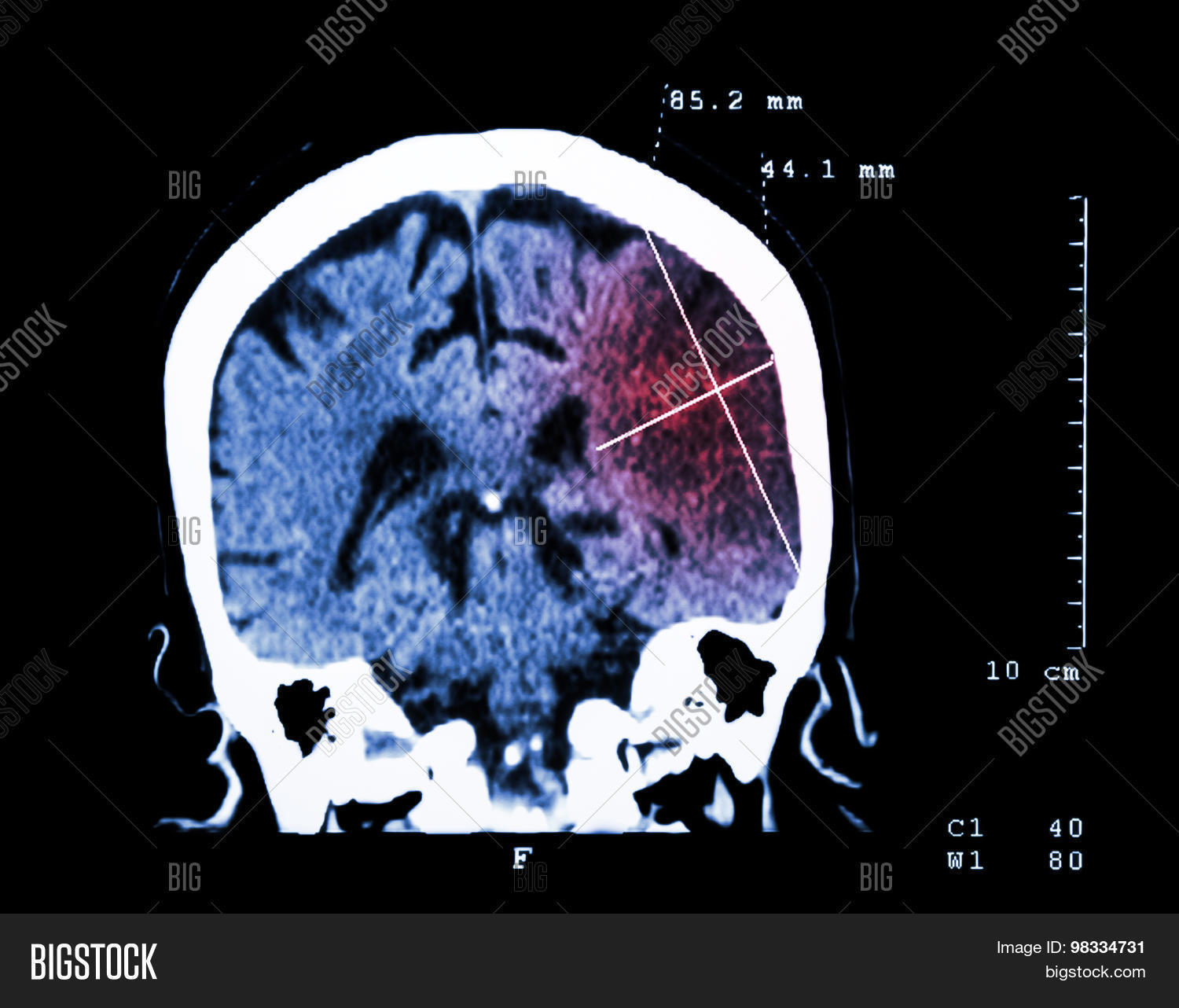 cerebral infarction at left hemisphere ( ischemic stroke ) ( ct