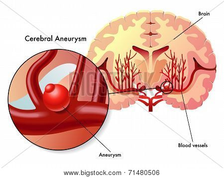 cerebral aneurysm